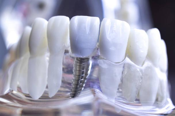 All On 4 Dental Implants In Perth And Why You Should Consider Them