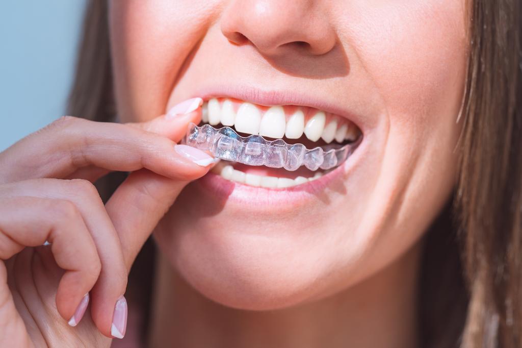 How Much Do Invisible Braces Cost in Australia?